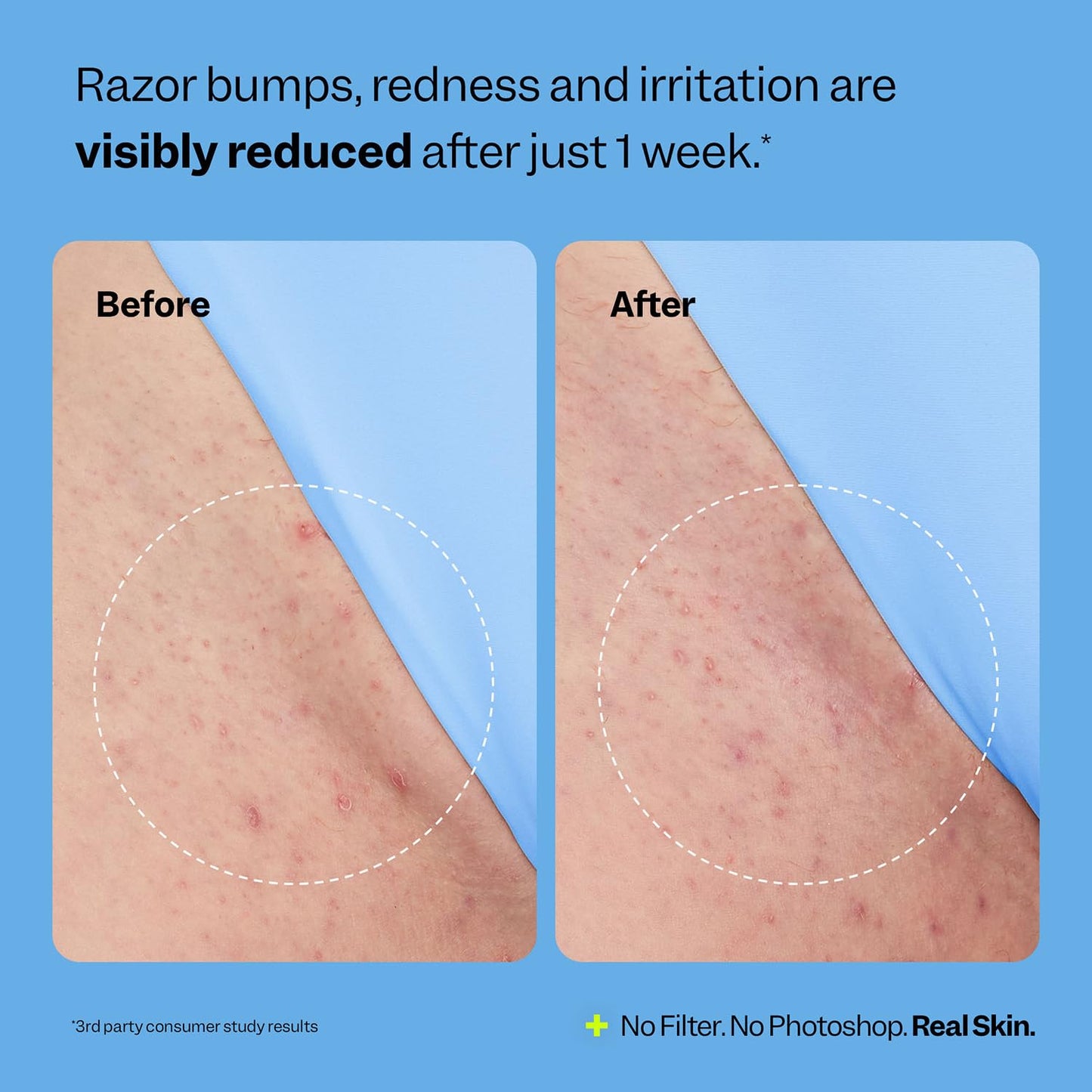Ingrown Hair Treatment